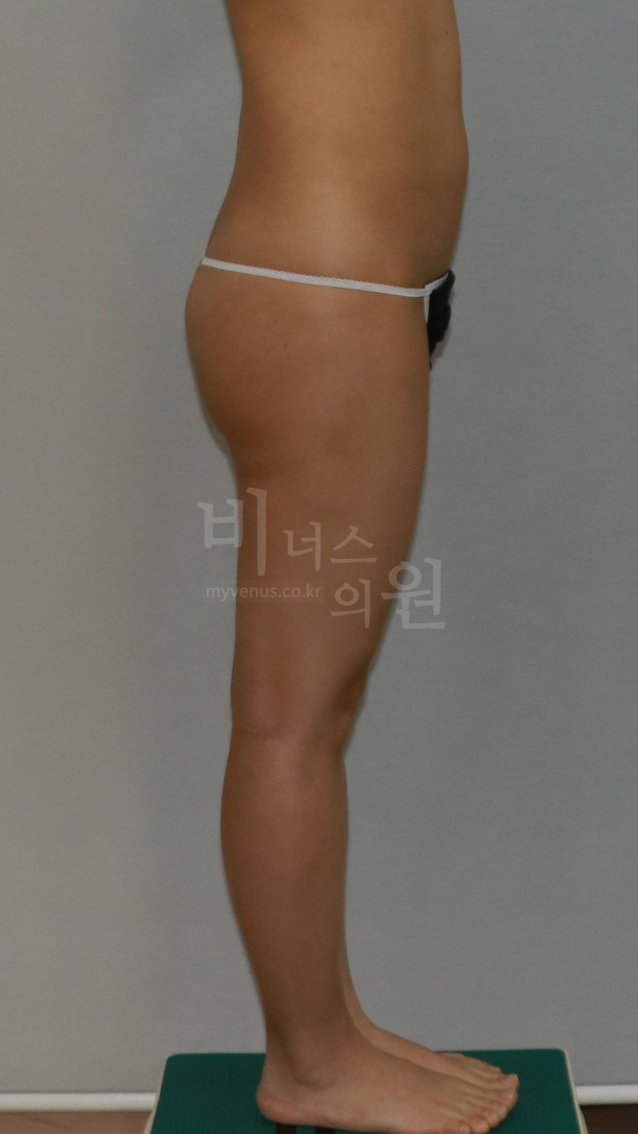 엉덩이축소 지방흡입 수술 전 좌측면