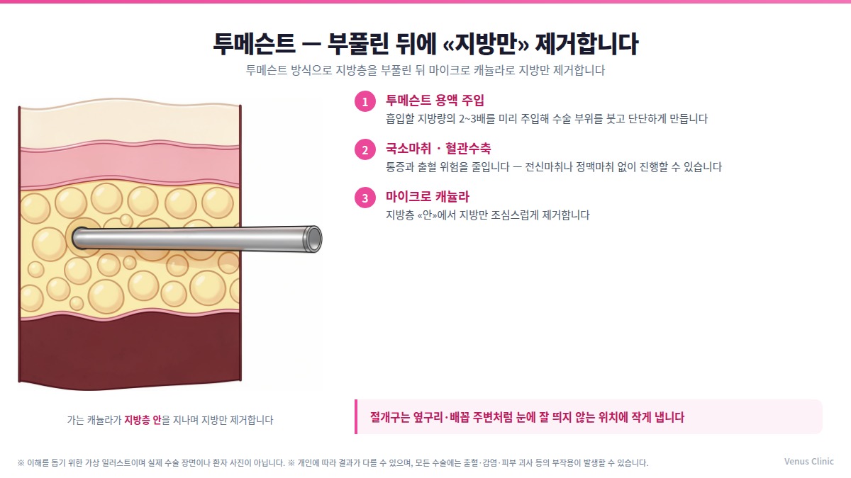투메슨트 복부 지방흡입 3단계 인포그래픽 — 용액 주입, 국소마취·혈관수축, 마이크로 캐뉼라로 지방층 안에서 제거