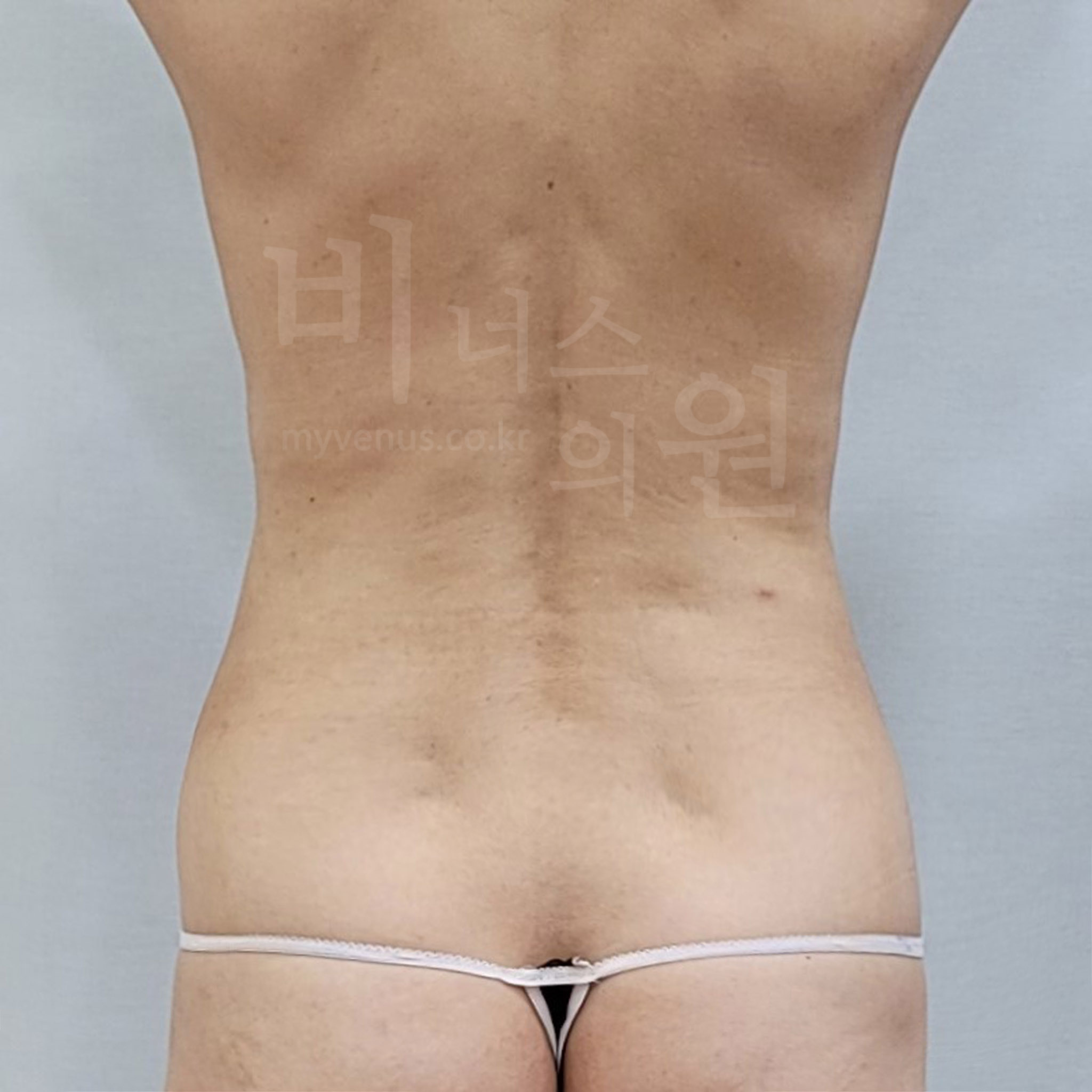 복부 지방흡입 수술 전 후면 사진