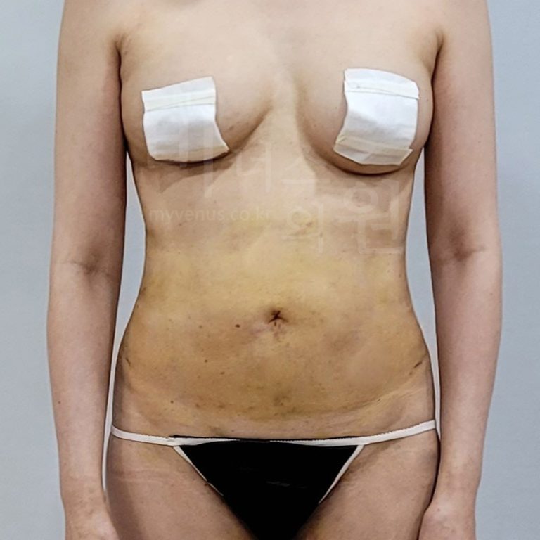 복부 지방흡입 수술 후 정면 사진