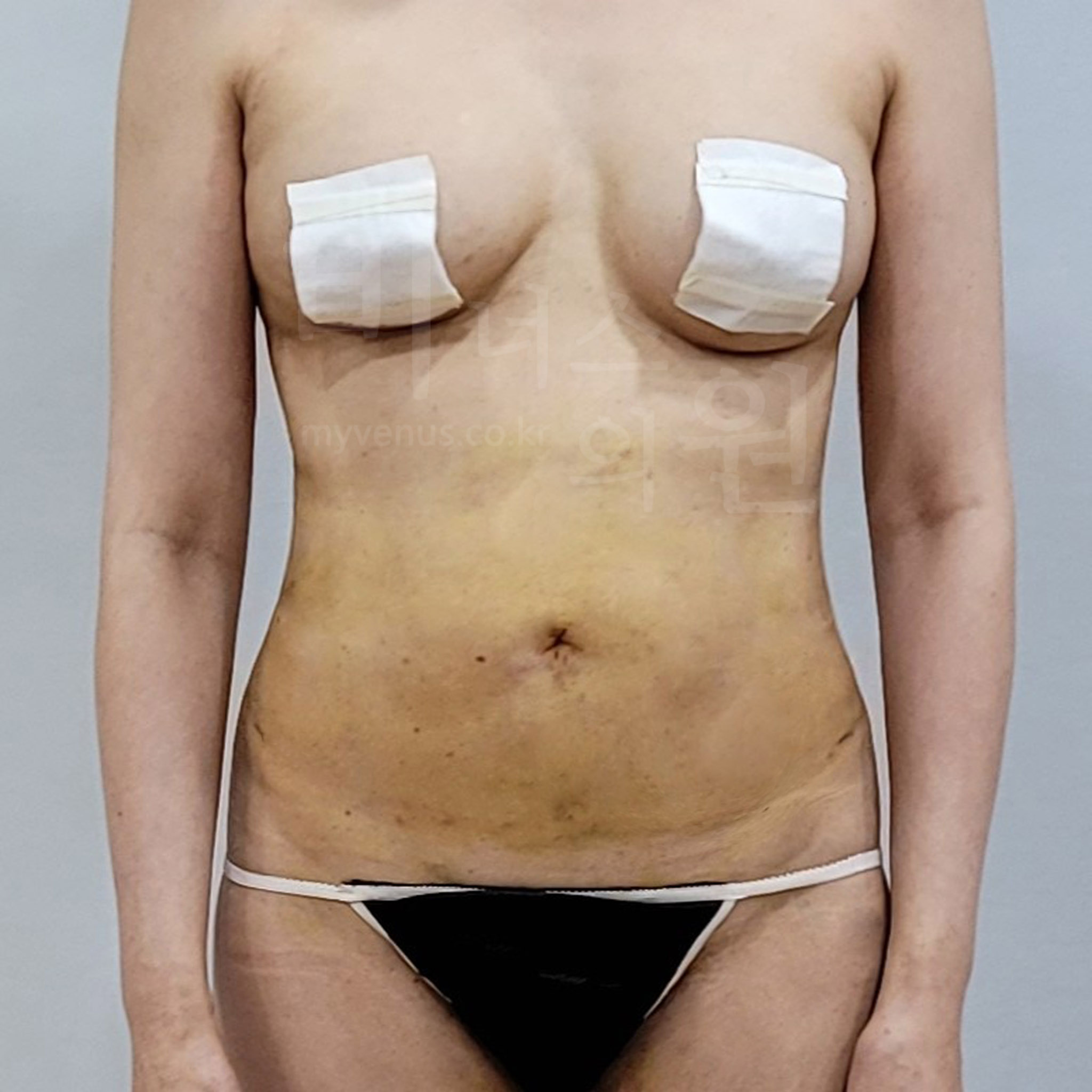 복부 지방흡입 수술 후 정면 사진