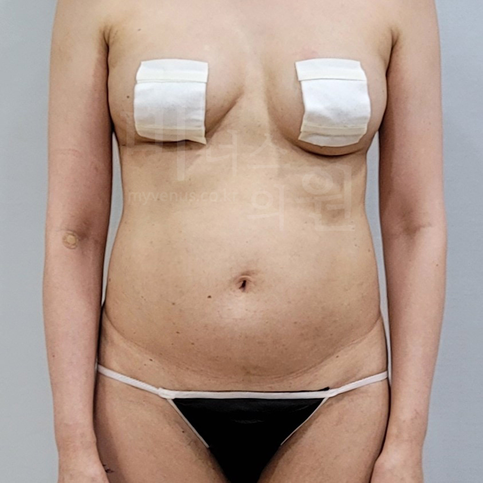 복부 지방흡입 수술 전 정면 사진