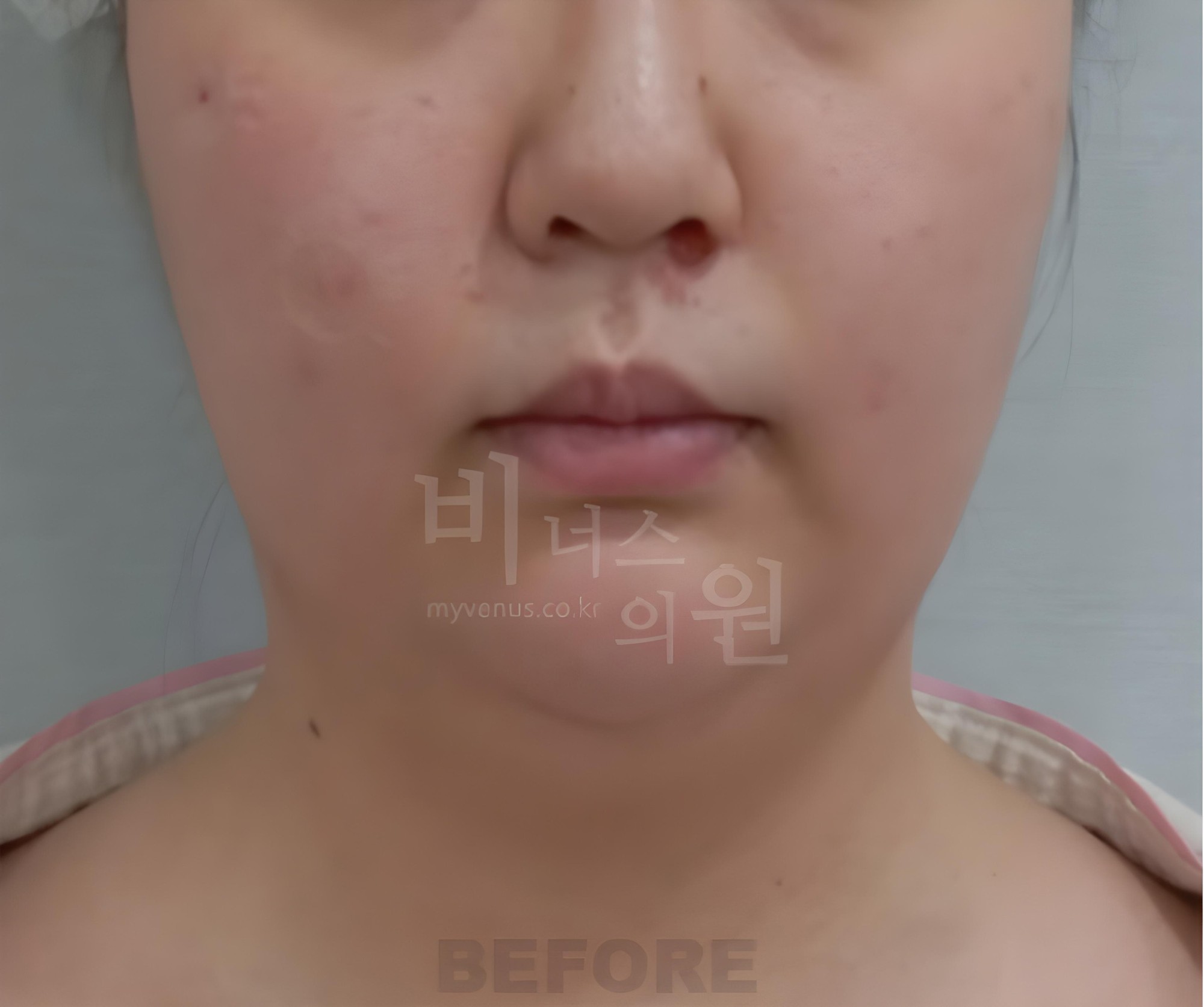 턱지방흡입 수술 전 정면