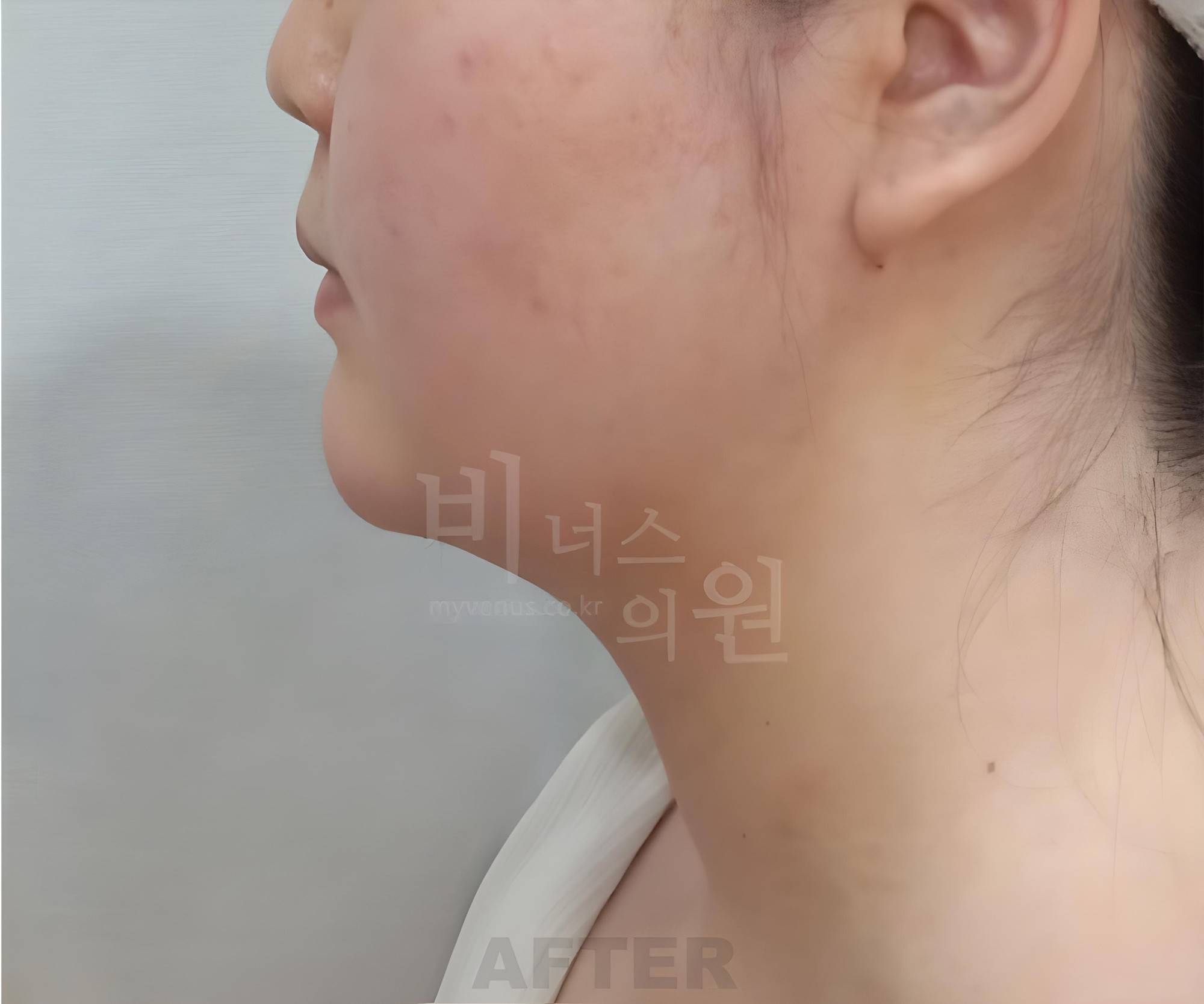 턱지방흡입 수술 후 측면