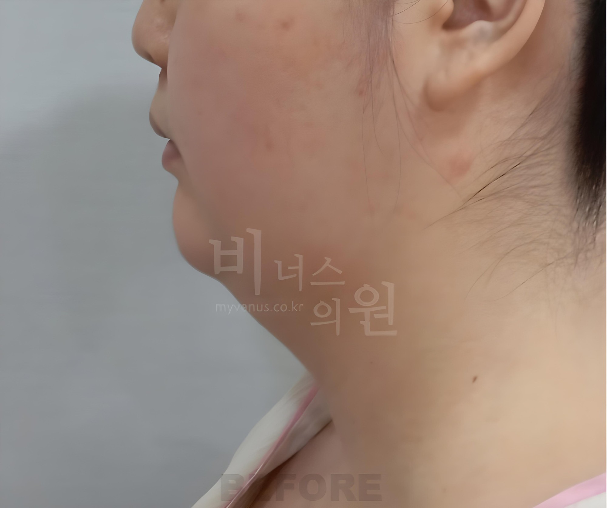 턱지방흡입 수술 전 측면