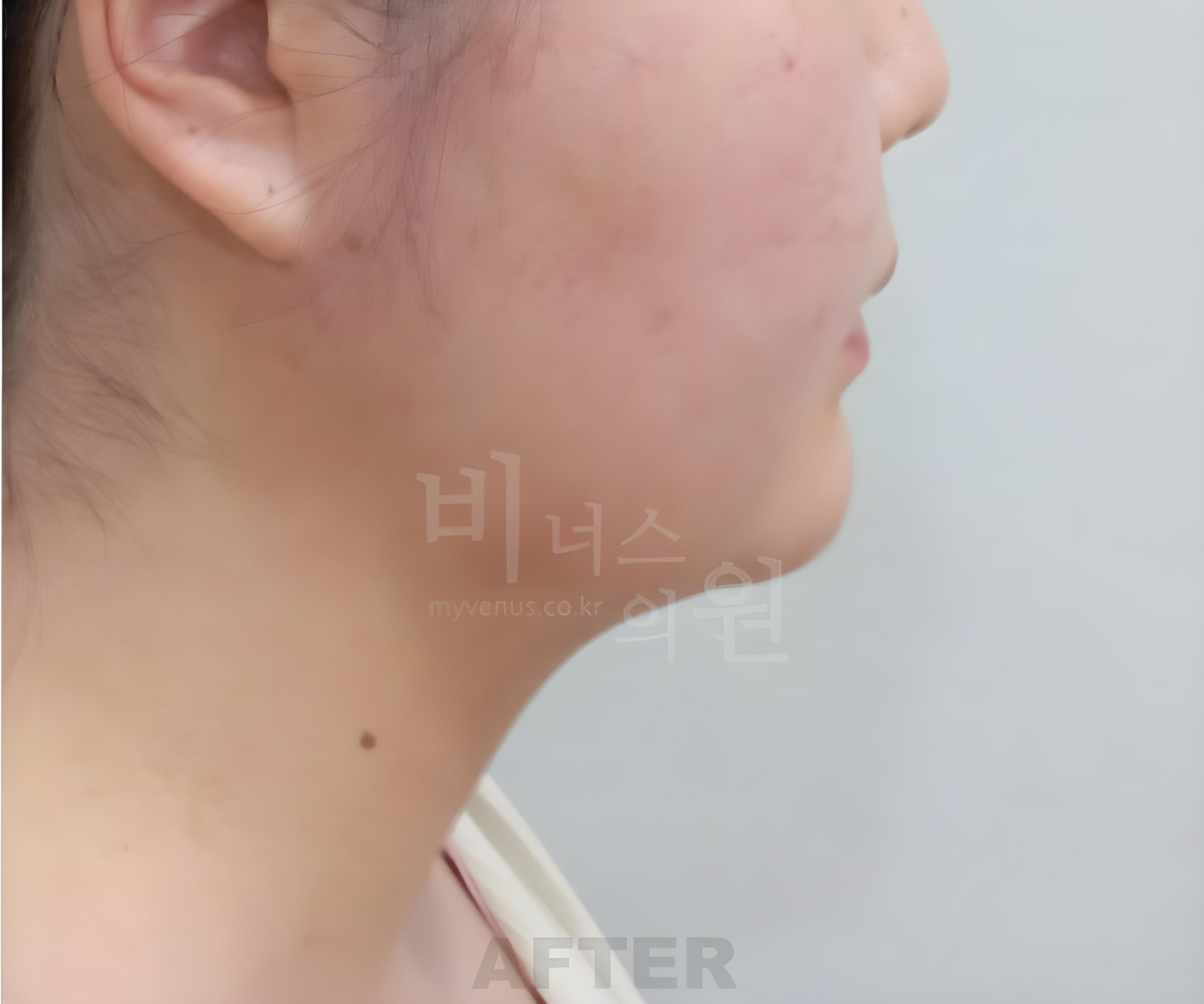 턱지방흡입 수술 후 반대쪽 측면