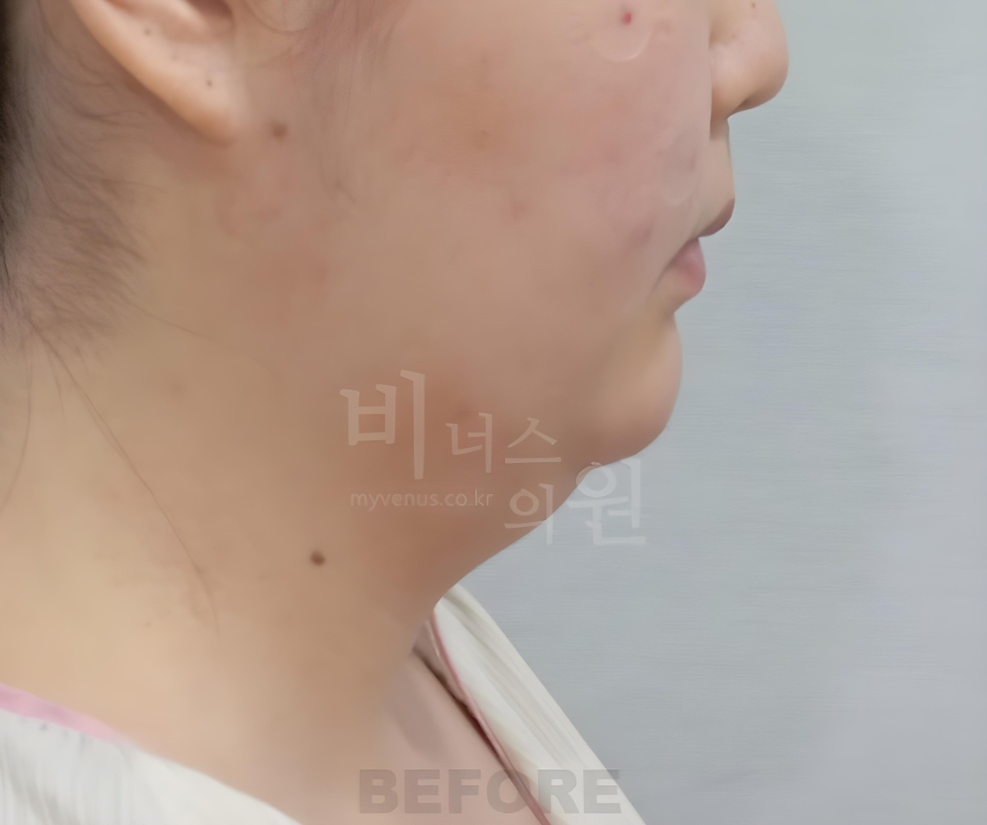 턱지방흡입 수술 전 반대쪽 측면