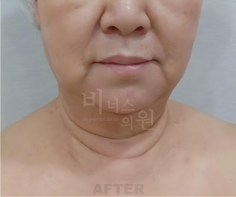 턱지방흡입, 이중턱만? 볼과 목까지? — 흡입 범위로 달라지는 비용과 선택 기준