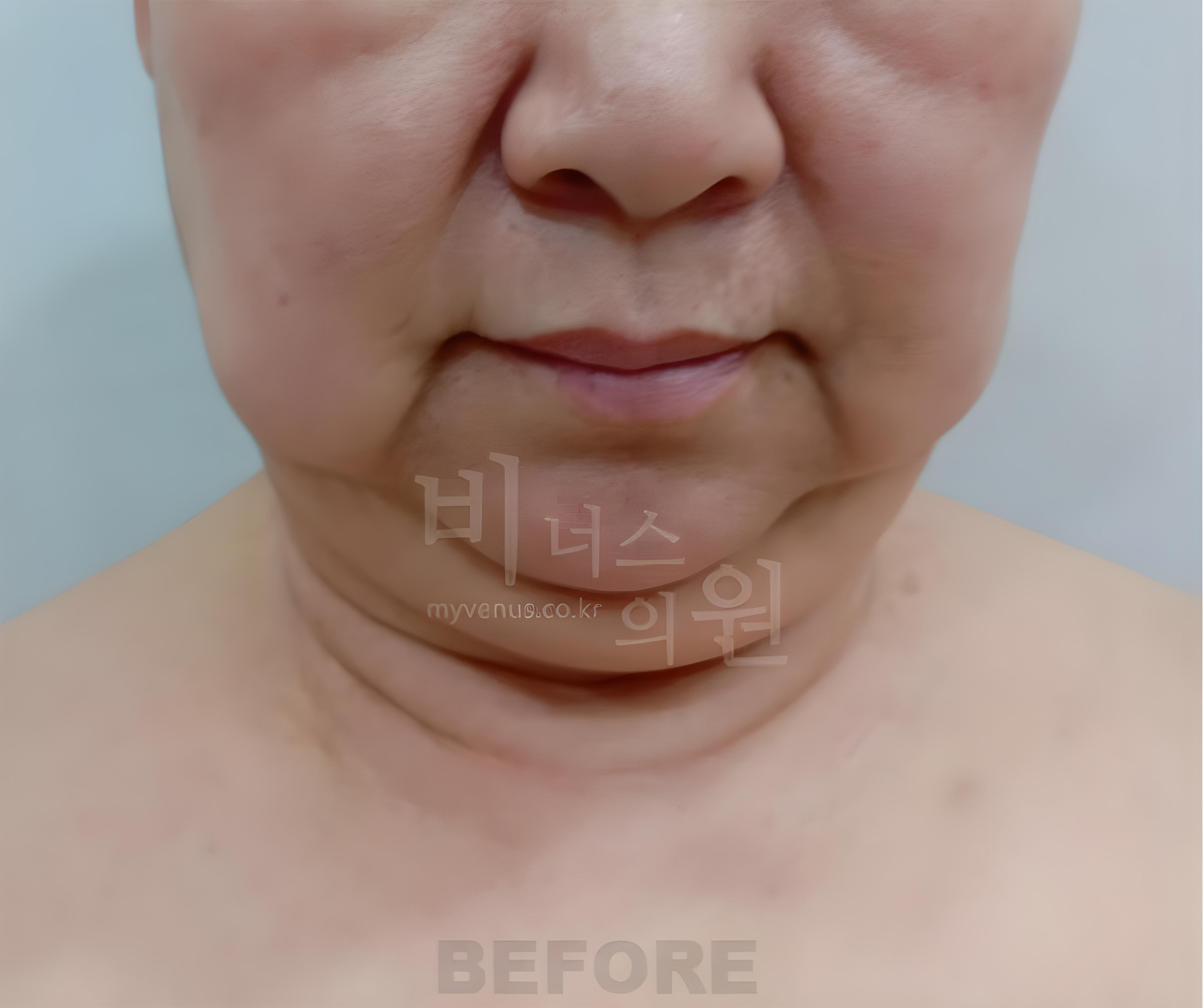 턱·목 지방흡입 수술 전 정면 사진