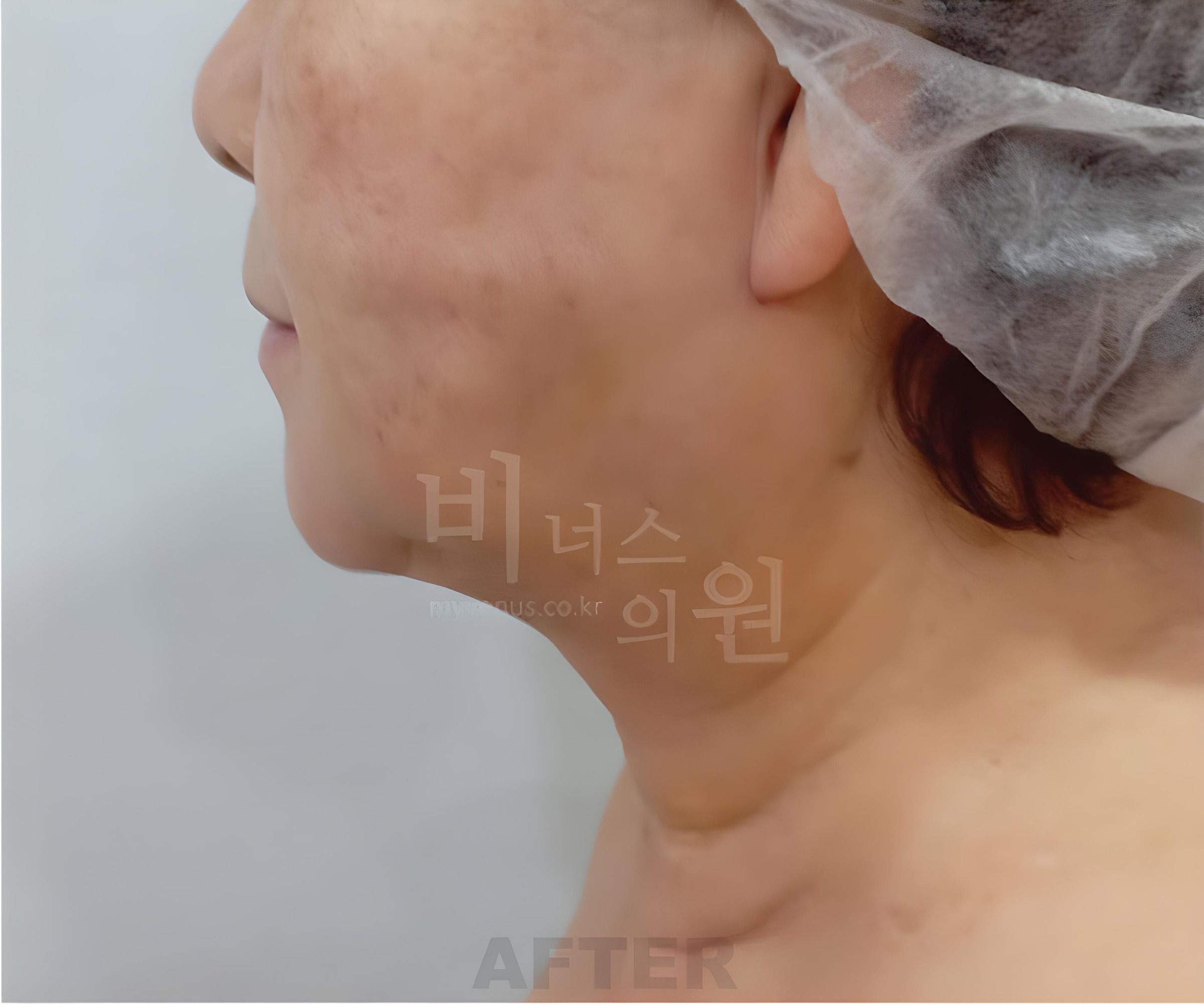 턱·목 지방흡입 수술 후 측면 사진