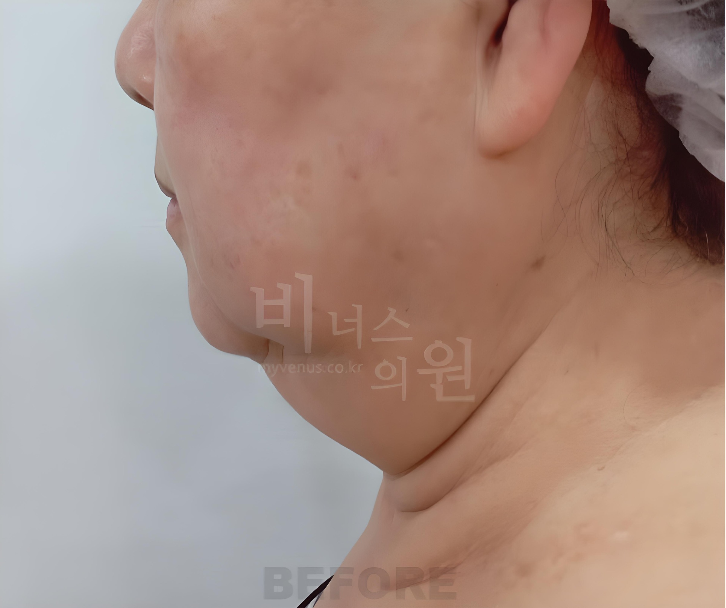 턱·목 지방흡입 수술 전 측면 사진