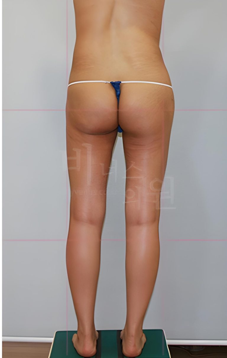 엉덩이처짐, 지방흡입으로 좋아질까요? 자주 나오는 질문 5가지로 오해 바로잡기