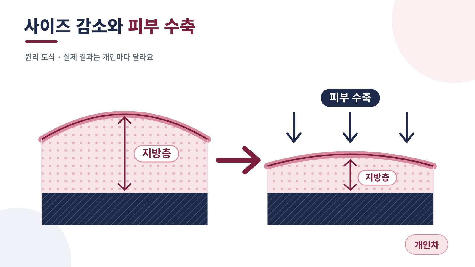 사이즈 감소와 피부 수축이 함께 일어나는 표층지방흡입 원리를 보여주는 도식, 실제 결과는 개인마다 다름