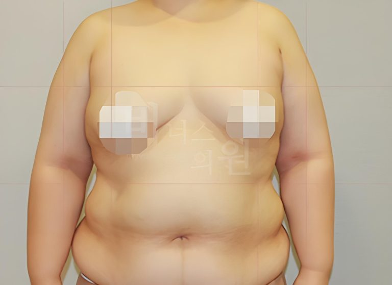팔뚝지방흡입 비용, 무엇을 먼저 봐야 후회가 없을까 — 상담 전 선택 가이드