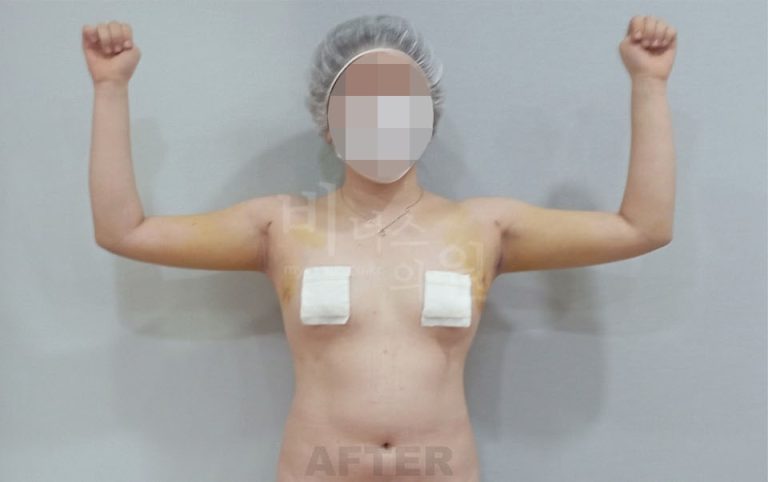 팔뚝지방흡입 잘하는 곳, 가격표보다 먼저 봐야 할 3가지 기준