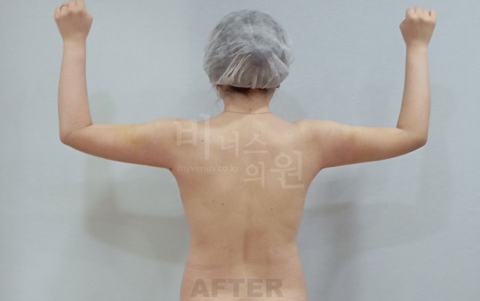 팔뚝지방흡입 수술 후 후면 팔 굽힌 자세