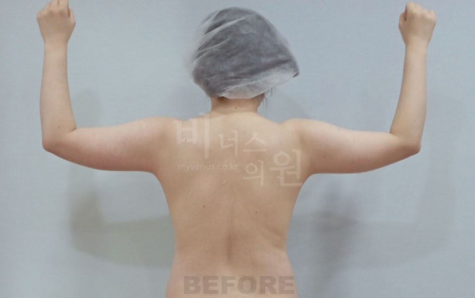 팔뚝지방흡입 수술 전 후면 팔 굽힌 자세