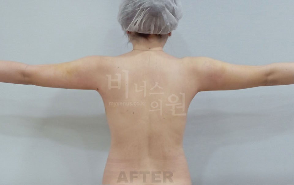 팔뚝지방흡입 수술 후 후면 팔 수평 자세