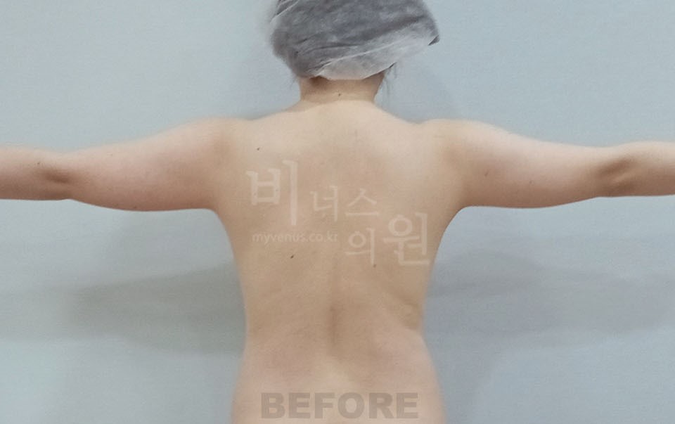 팔뚝지방흡입 수술 전 후면 팔 수평 자세