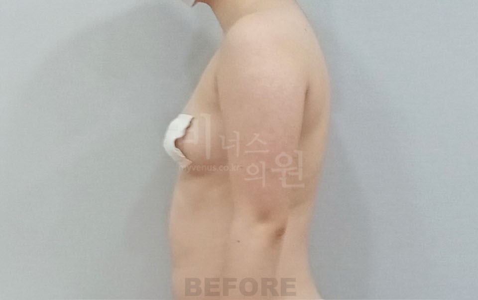 팔뚝지방흡입 수술 전 측면