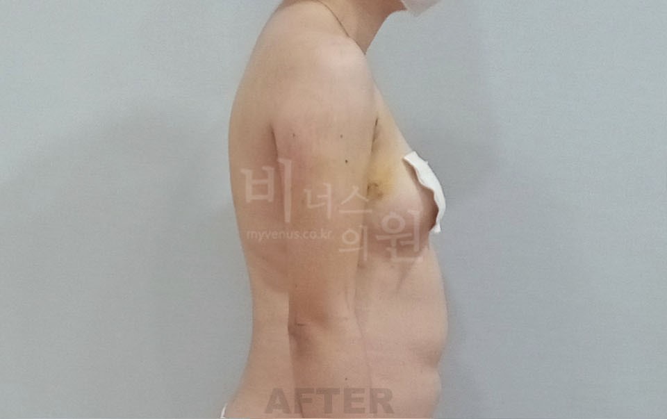 팔뚝지방흡입 수술 후 측면