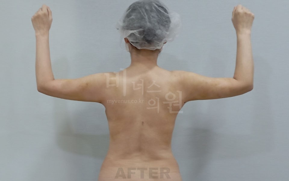 팔뚝지방흡입 수술 후 후면