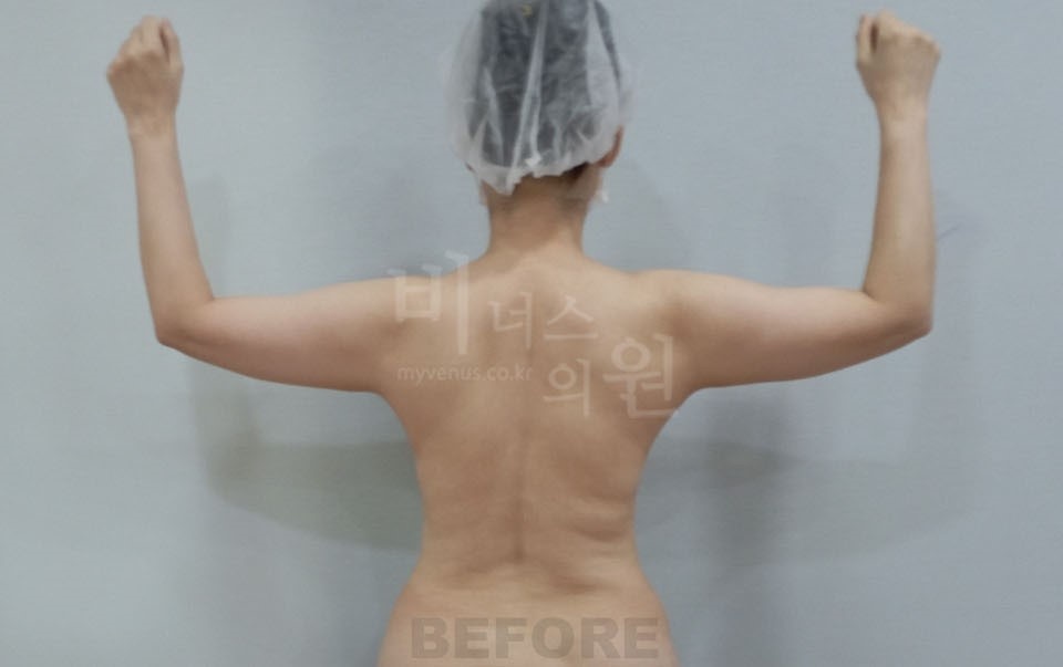 팔뚝지방흡입 수술 전 후면