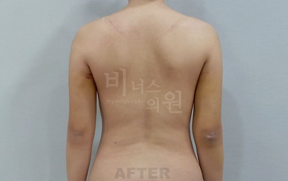 팔뚝지방흡입 수술 후 후면 팔 내린 자세