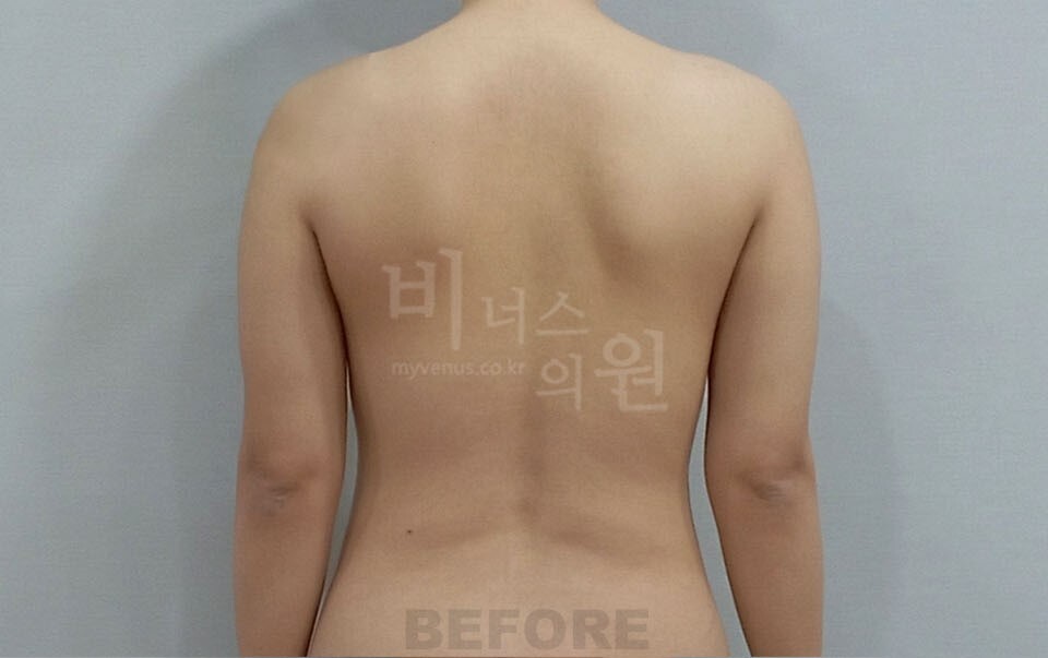 팔뚝지방흡입 수술 전 후면 팔 내린 자세