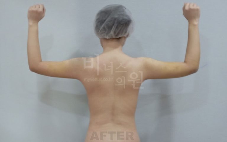 팔뚝지방흡입 수술 후 후면 팔 올린 자세