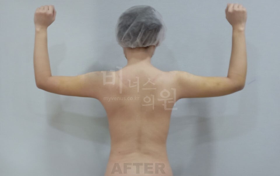 팔뚝지방흡입 수술 후 후면 팔 올린 자세
