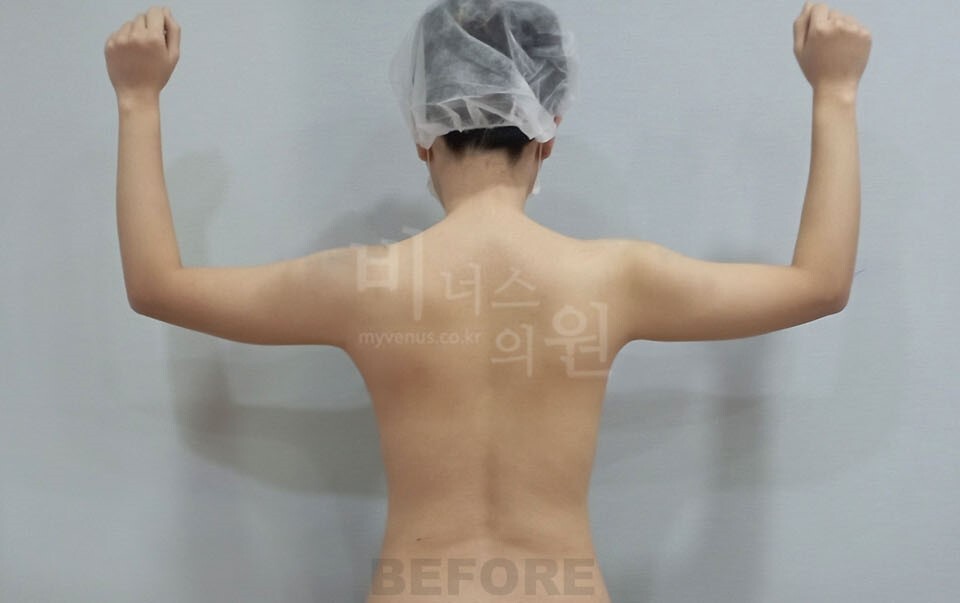 팔뚝지방흡입 수술 전 후면 팔 올린 자세