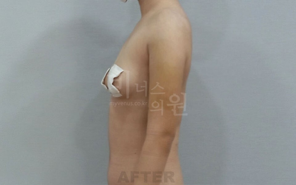 팔뚝지방흡입 수술 후 우측면