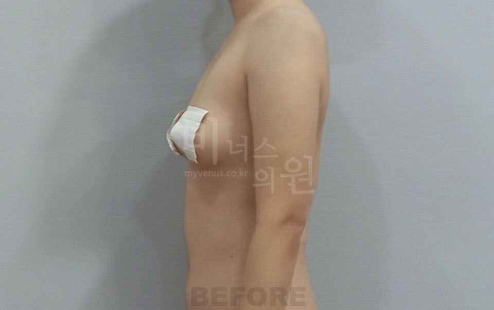 팔뚝지방흡입 수술 전 우측면