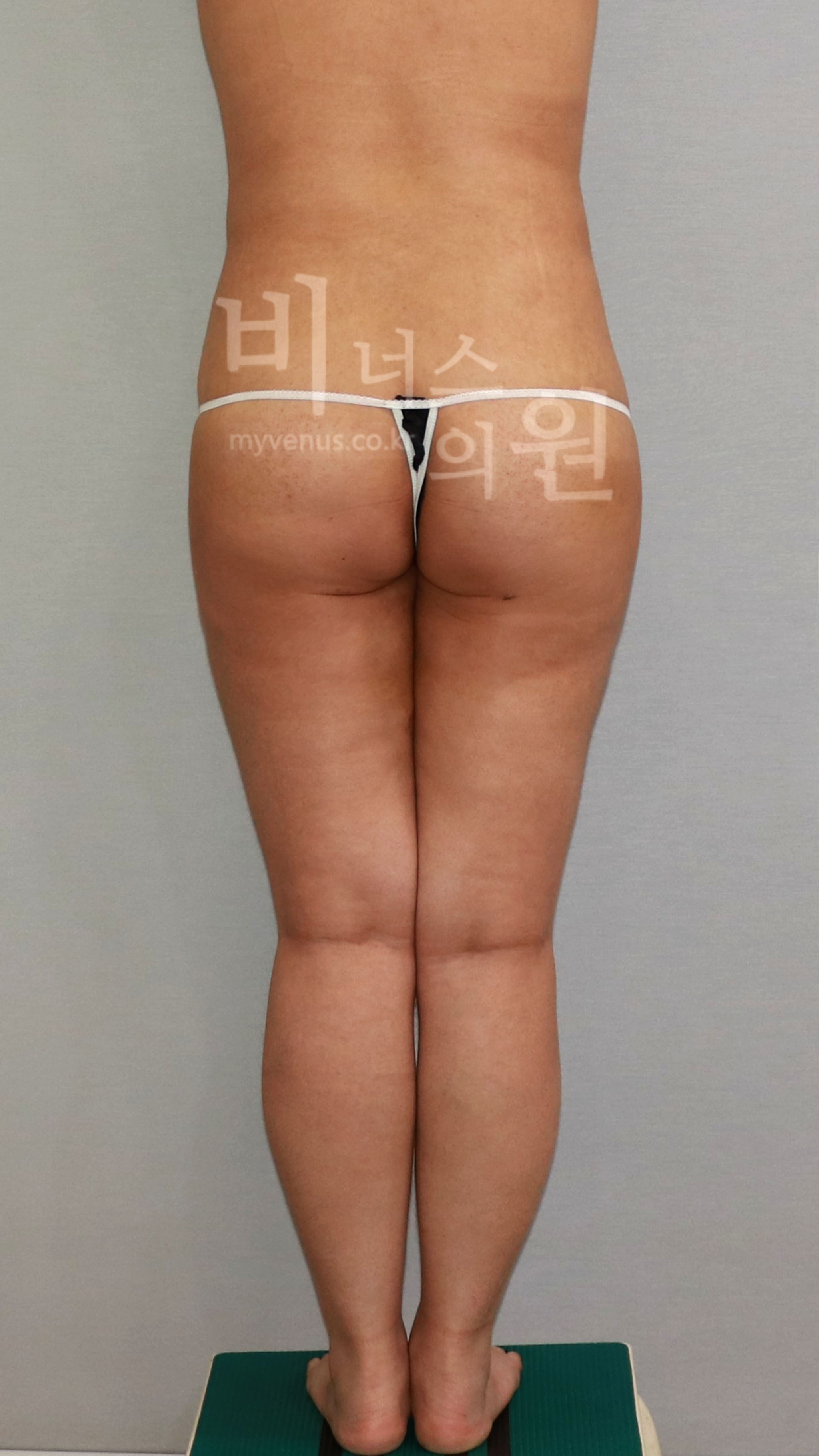 엉덩이축소 지방흡입 수술 후 후면