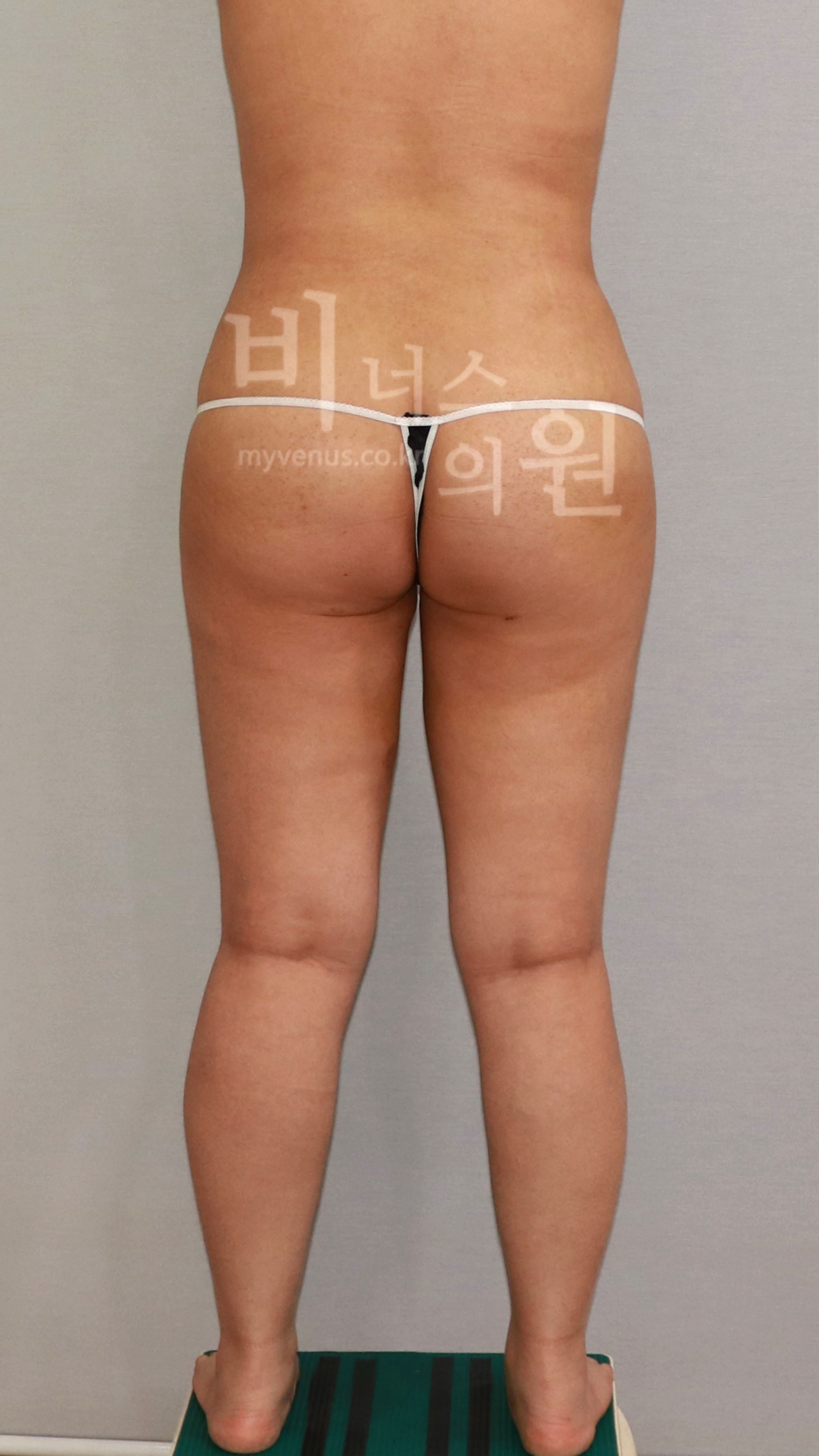 엉덩이축소 지방흡입 수술 후 후면