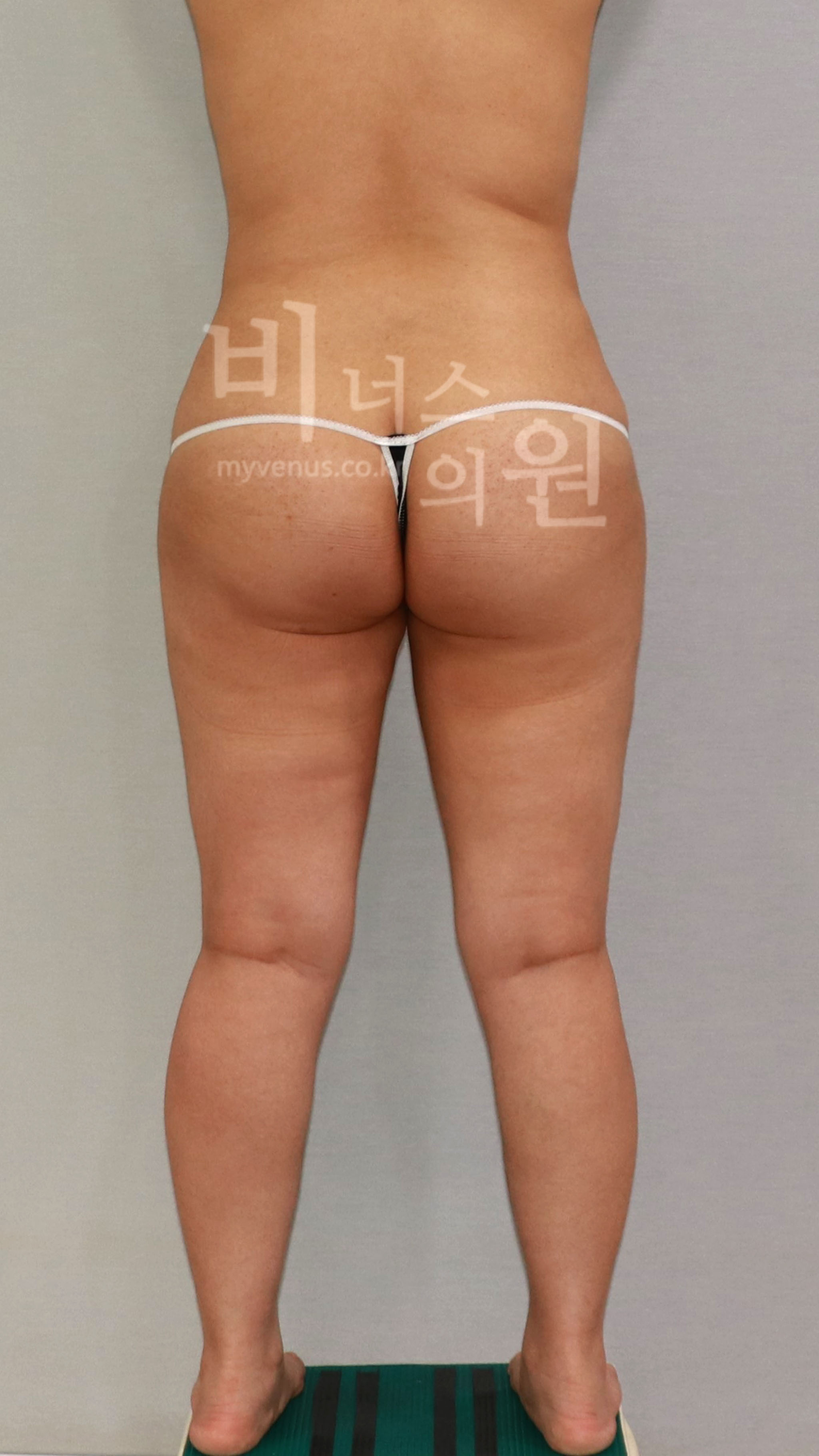엉덩이축소 지방흡입 수술 전 후면