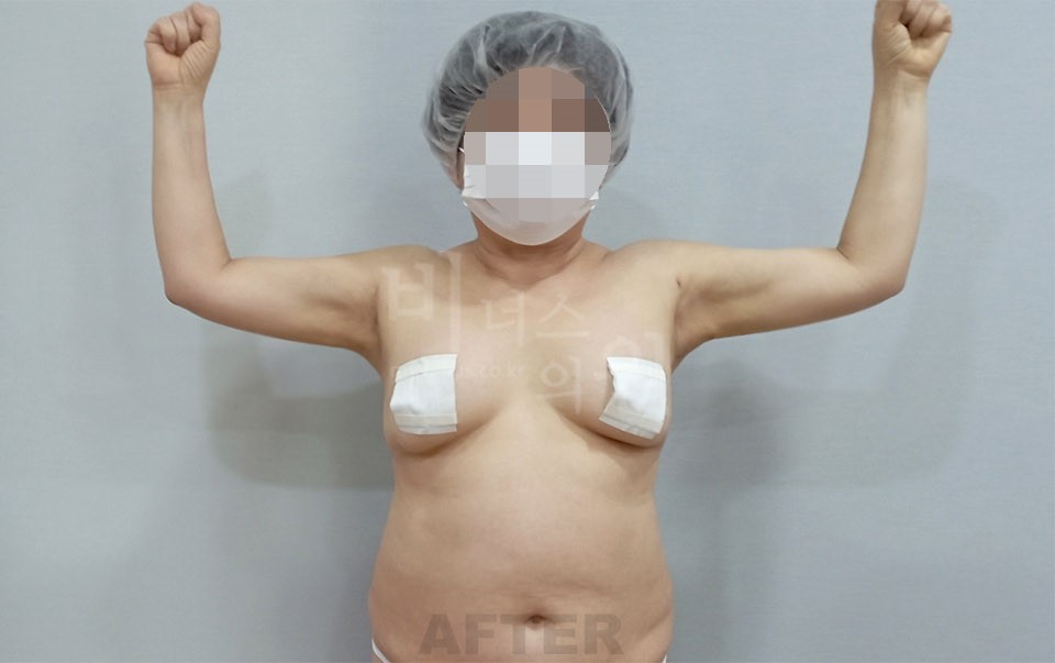 팔뚝지방흡입 수술 후 정면