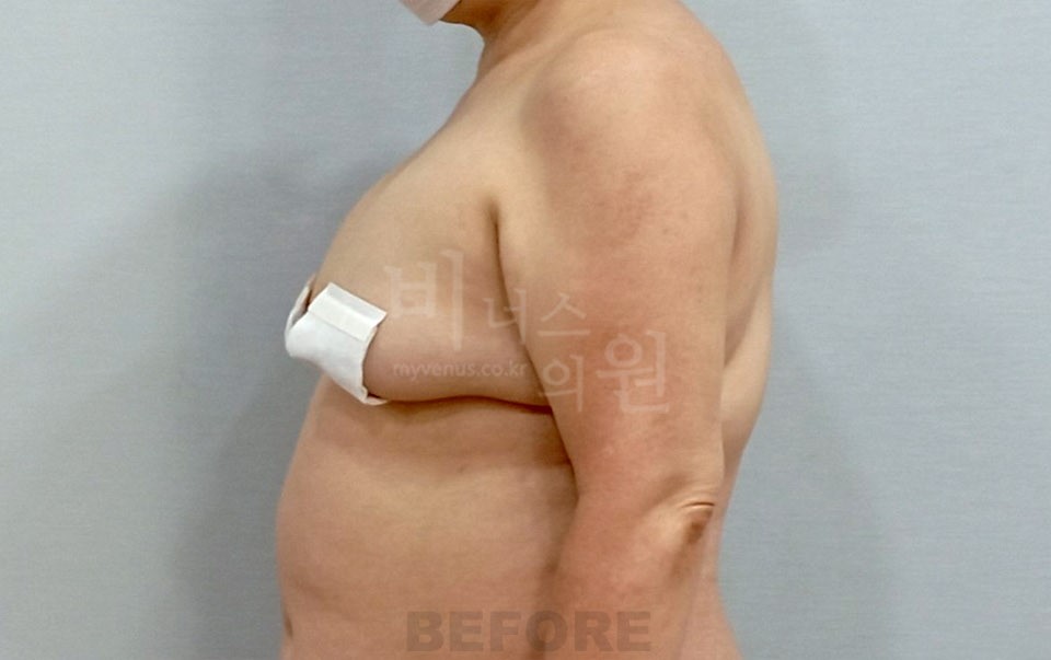 팔뚝지방흡입 수술 전 측면