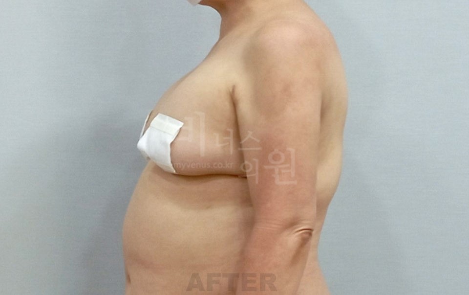팔뚝지방흡입 수술 후 측면