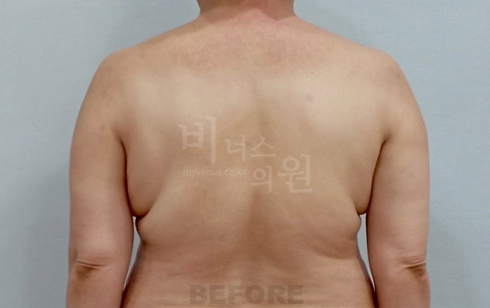 팔뚝지방흡입 수술 전 후면
