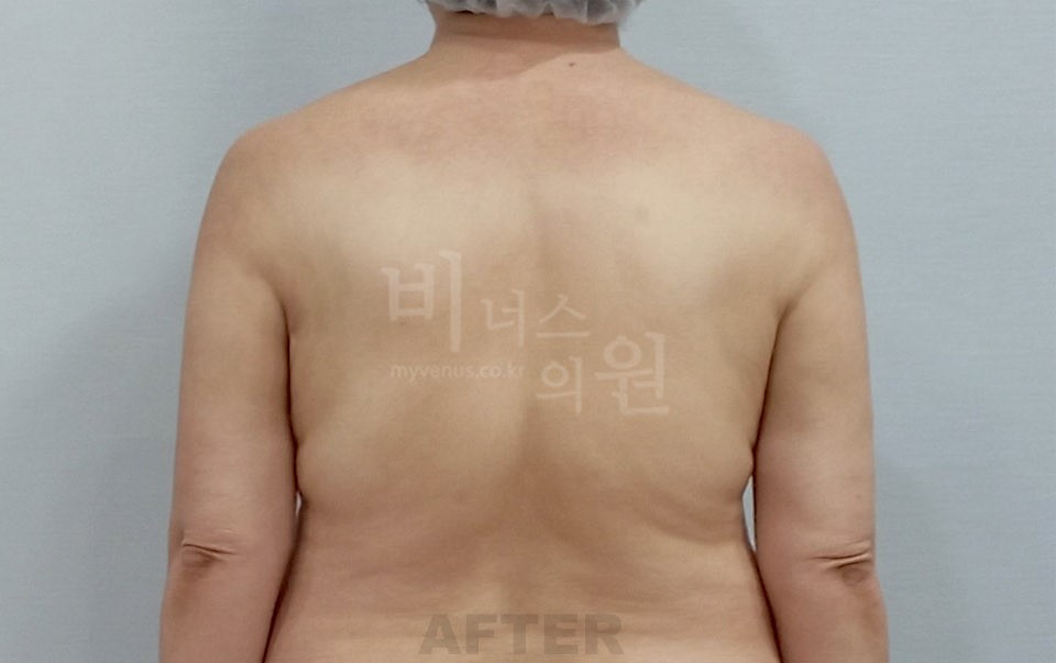 팔뚝지방흡입 수술 후 후면
