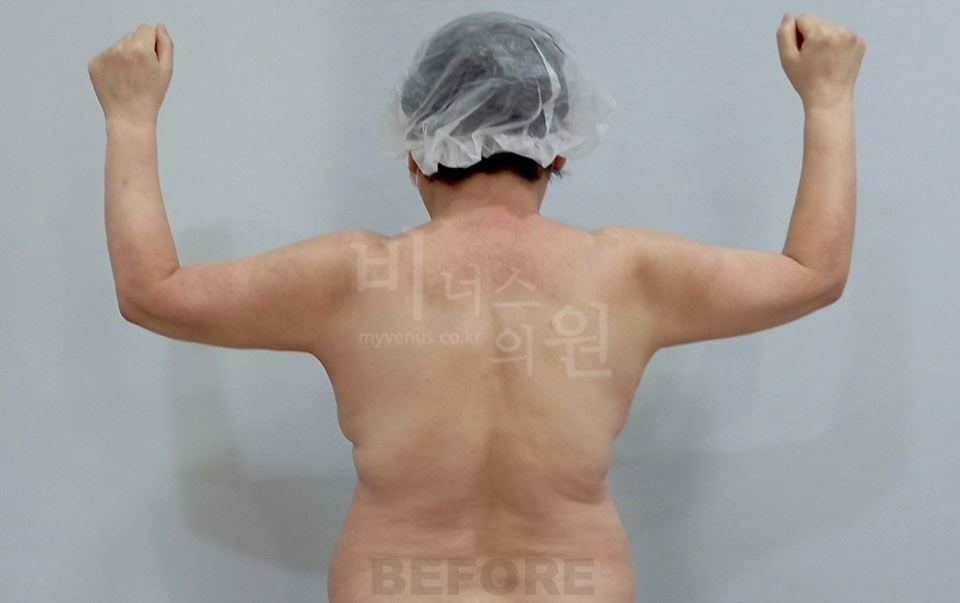 팔뚝지방흡입 수술 전 후면 팔 올린 자세