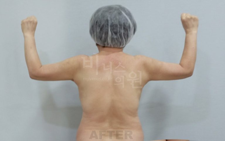 팔뚝지방흡입 수술 후 후면 팔 올린 자세