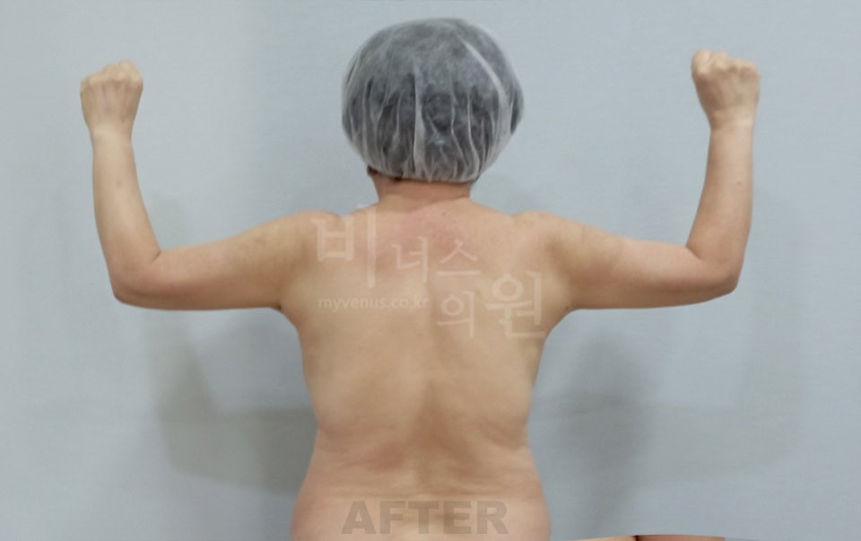 팔뚝지방흡입 수술 후 후면 팔 올린 자세