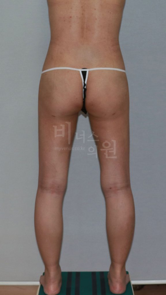 엉덩이 지방흡입 수술 후 후면 발 벌림 자세 비너스의원