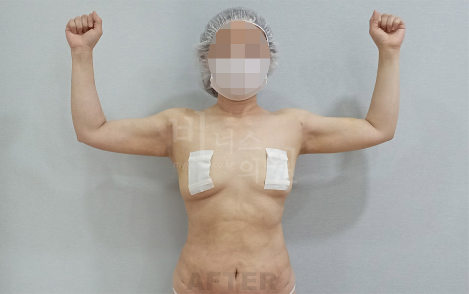 팔뚝지방흡입 사례 정면(팔 올림) — 수술 후 (부천 비너스의원)