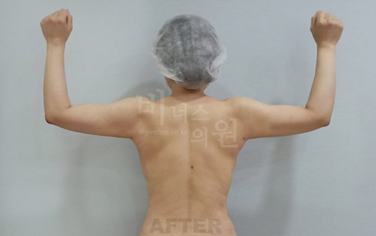 팔뚝지방흡입 사례 후면(팔 올림) — 수술 후 (부천 비너스의원)