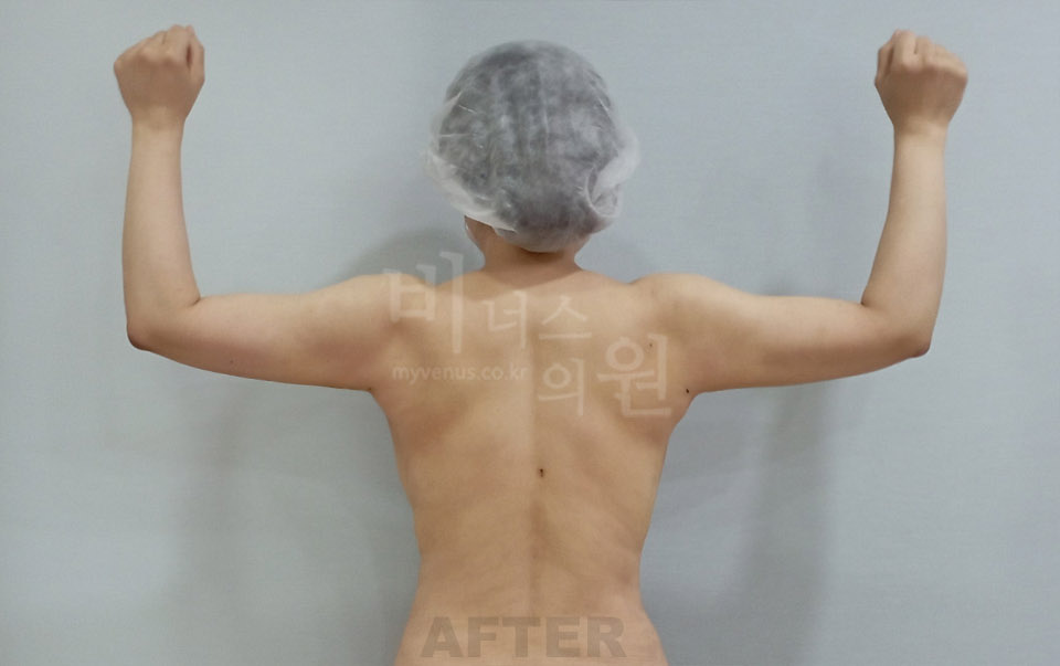팔뚝지방흡입 사례 후면(팔 올림) — 수술 후 (부천 비너스의원)