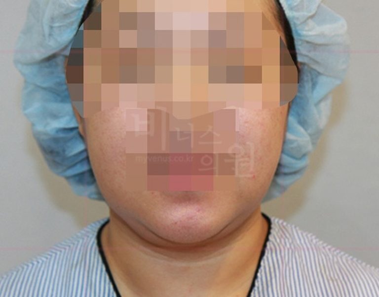 턱살, 다이어트로 해결될까 지방흡입이 맞을까? 시간·회복·흉터·비용을 한 장에 놓고 고르는 법